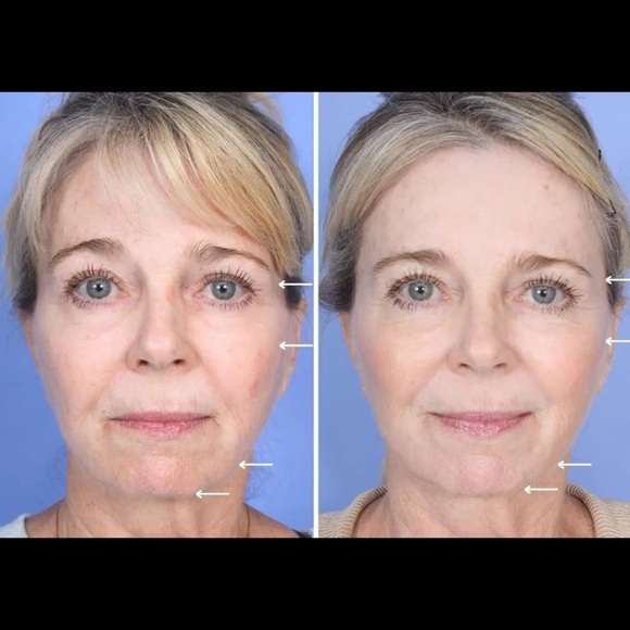 Professional PLLA Collagen Booster
- Volumizing & Skin Firming (1
Sealed Vial) - Picture 3 of 5